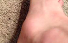 accessory-bone-problems-accessory-navicular