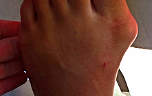 bunions