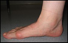 flat-feet