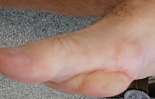 plantar-fibroma