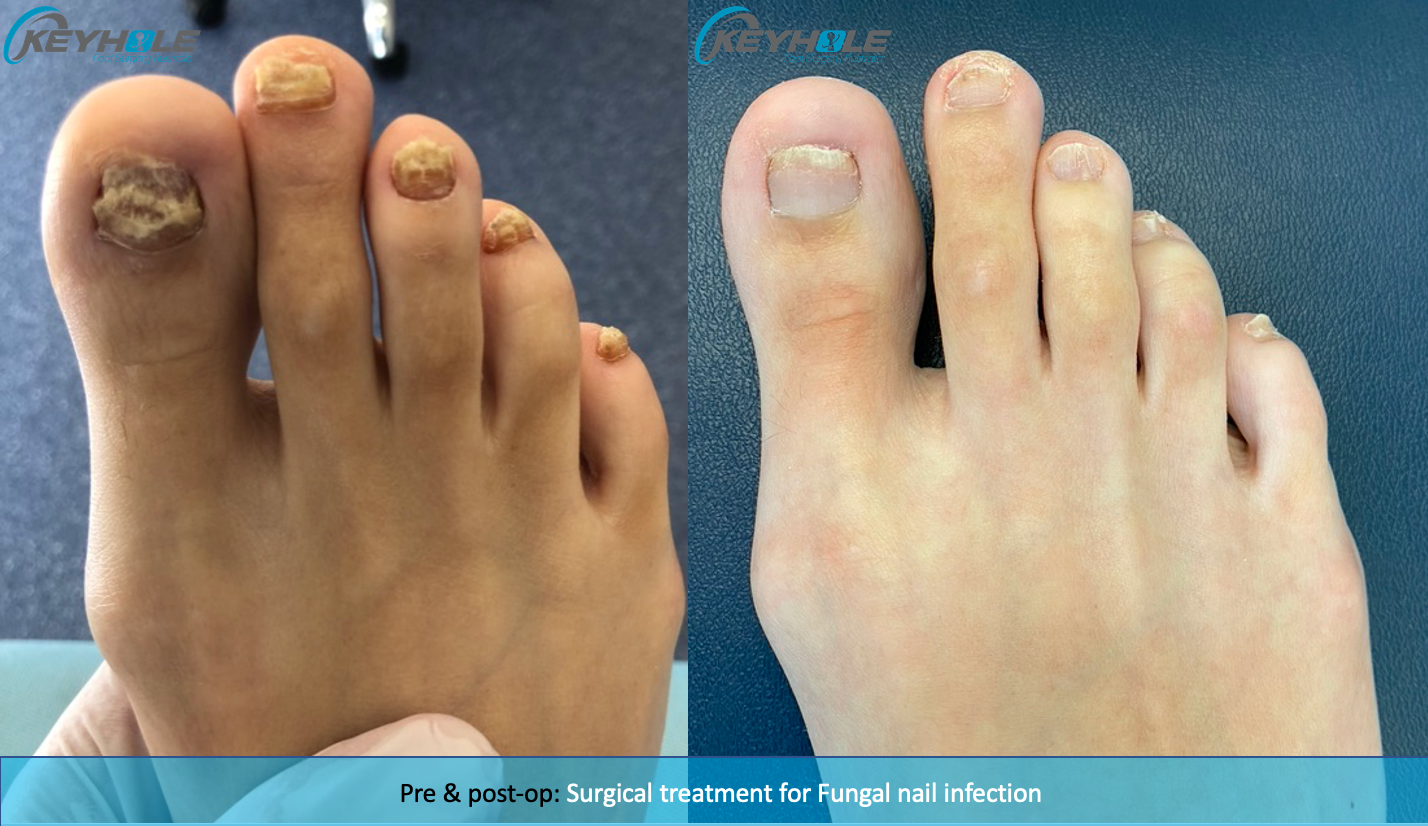 New Breakthrough for Fungal Nails and Toe Nail Fungus Treatment