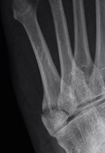 fractures