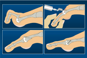 weil osteotomy