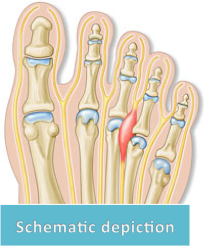 morton's neuroma