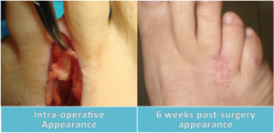 morton's neuroma