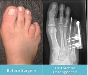 brachymetatarsia surgery