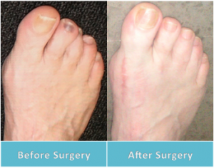 smart toe