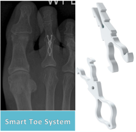 hammertoe surgery perth
