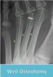 metatarsalgia surgery perth