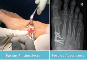 midfoot fusion