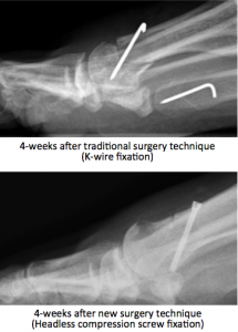 bunion surgery perth
