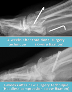 bunion surgery
