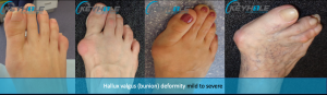 bunion surgery perth