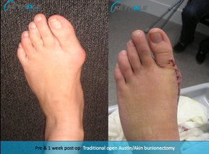 bunion surgery perth