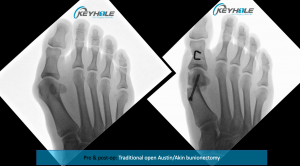 bunion surgery perth