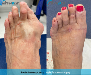 keyhole bunion surgery