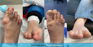 keyhole bunion surgery