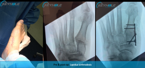 bunion surgery perth