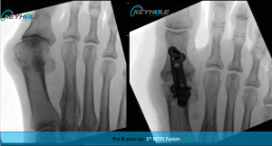 hallux rigidus surgery perth