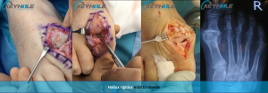 hallux rigidus surgery perth