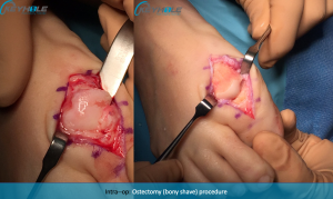 hallux rigidus surgery perth