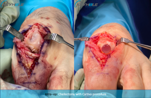 hallux rigidus surgery perth