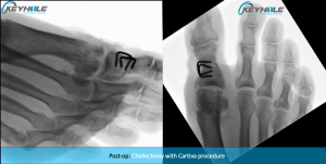 hallux rigidus surgery perth