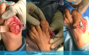 hallux rigidus surgery perth