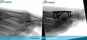 hallux rigidus surgery perth