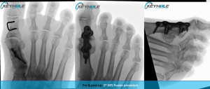 hallux rigidus surgery perth