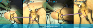 plantar fascia surgery