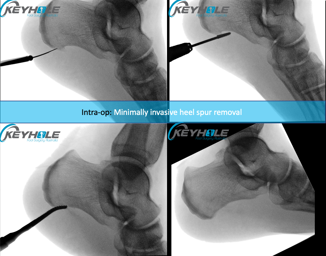 PDF) Bizarre calcaneal spur: A case report