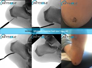 heel spur surgery