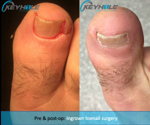 ingrown toenail surgery perth