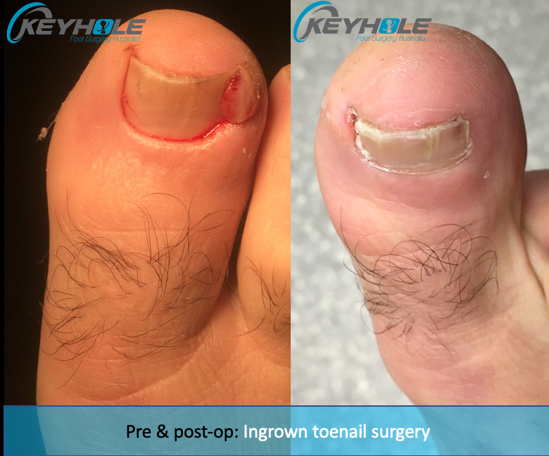 Nail Surgery (Partial Nail Avulsion - PNA) | In Room Procedure