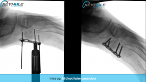 midfoot arthritis surgery perth