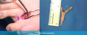 morton's neuroma surgery perth