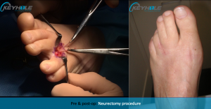 morton's neuroma surgery perth