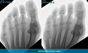 tailors bunion surgery perth