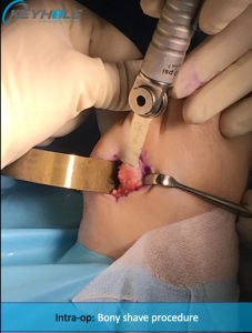 tailors bunion surgery perth
