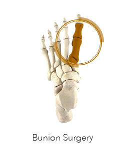 Bunion Surgery