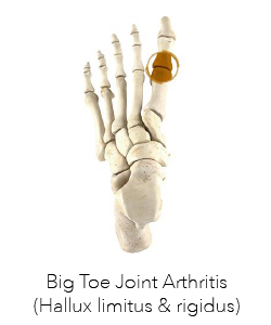 Podiatric Surgery Perth - Big Toe Joint Arthritis Surgery Perth - Logo
