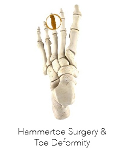 Hammertoe Surgery Perth - Foot Surgeon Perth - Perth Podiatric Surgery