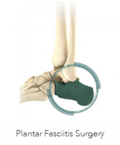 Foot Surgery Perth - Plantar Fasciitis Surgery Perth - Logo