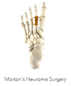 Morton’s Neuroma Surgery Perth - Perth Podiatric Surgery