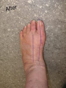 After Bunion Removal Surgery