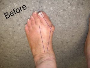 Before Bunion Removal Surgery