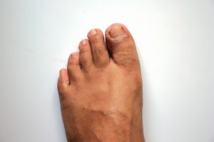 Foot Surgeon Perth, Ingrown Toenail Surgery Perth, Foot Specialist Perth, Podiatric Surgeon Perth, Perth Podiatric Surgery