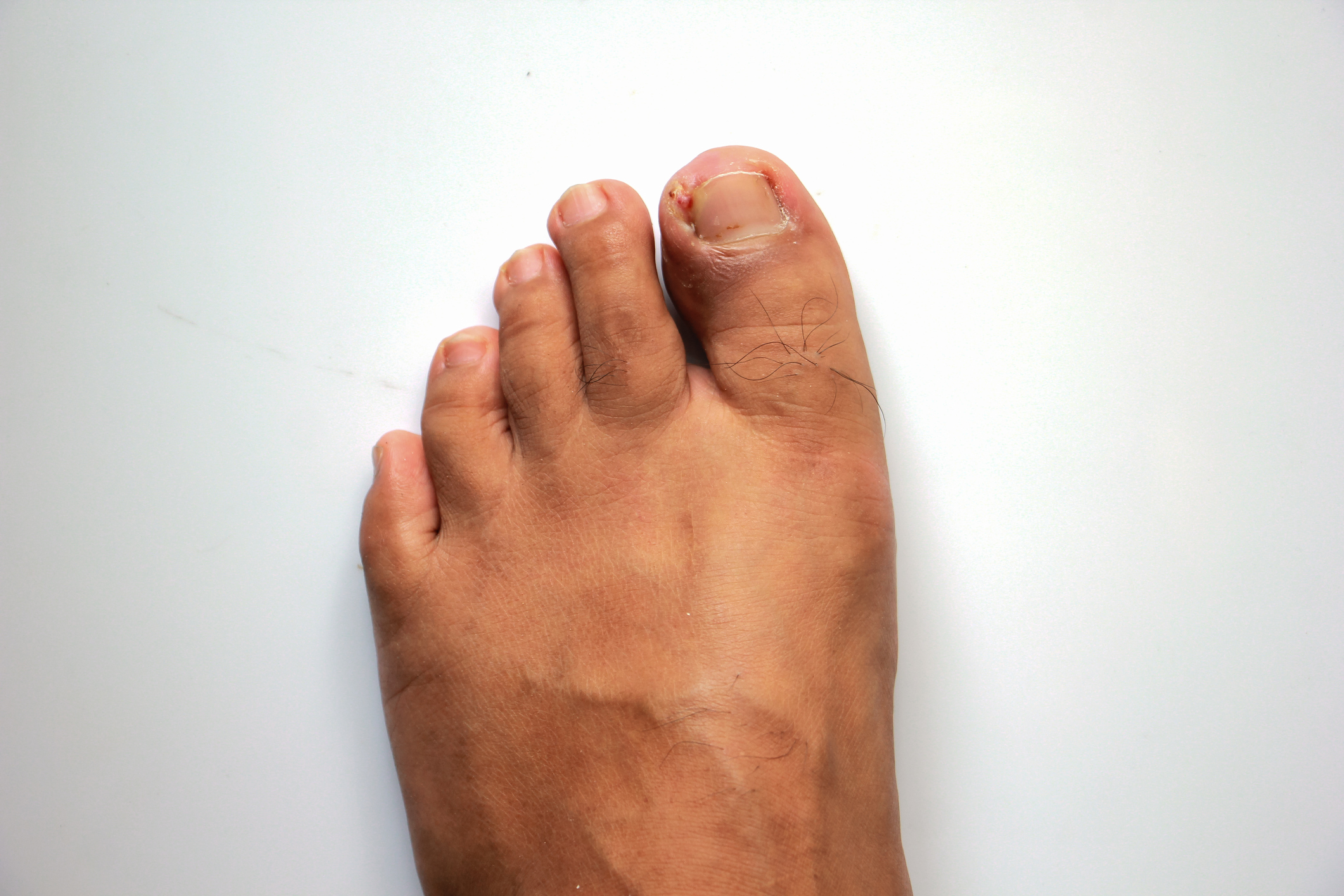 Foot Surgeon Perth, Ingrown Toenail Surgery Perth, Foot Specialist Perth, Podiatric Surgeon Perth, Perth Podiatric Surgery