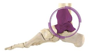 Ankle Surgery